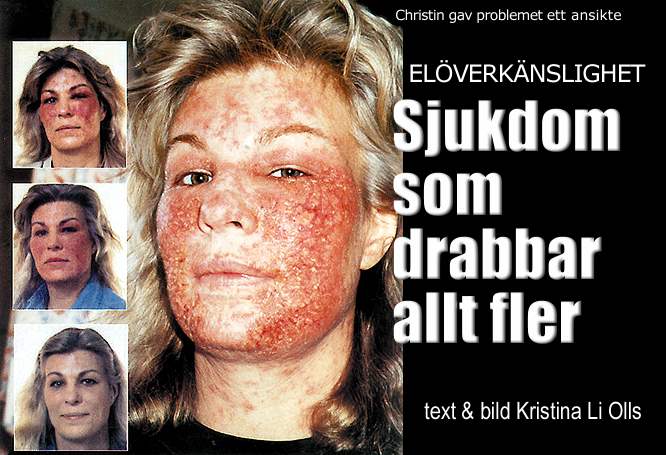 Christin gav problemet ett ansikte: Elverknslighet - sjukdom som drabbar allt fler av Kristina Li Olls